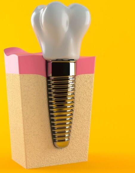 Dental Implants